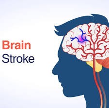 Brain Stroke