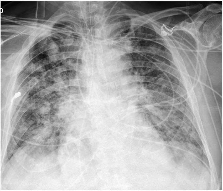 Deep learning project to detect COVID-19 from chest X-rays using CNN and transfer learning (VGG16).