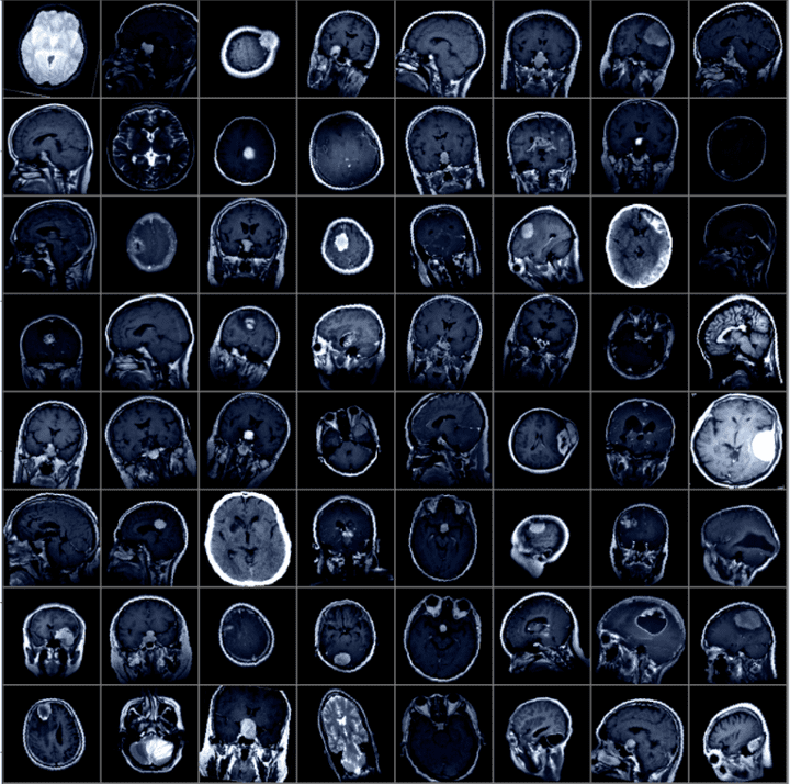 Brain Tumor Detection Using PyTorch