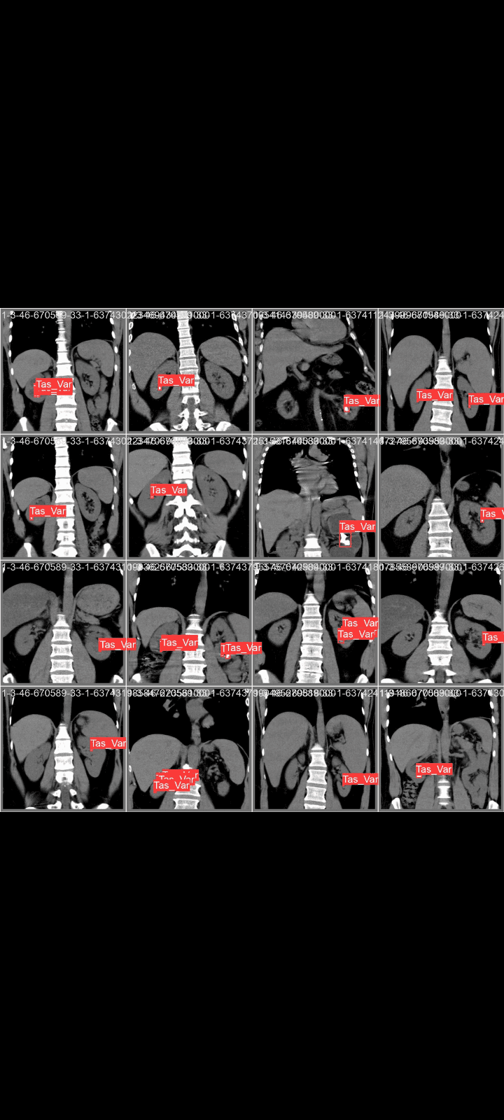 Kidney stones detection using yolov9