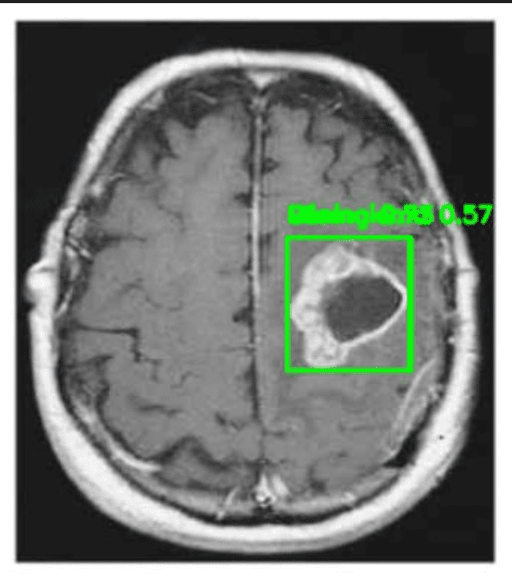 نظام الكشف عن أورام الدماغ باستخدام الذكاء الاصطناعي والتصوير الطبي