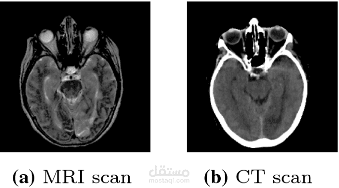 تحويل صور الأشعة المقطعية (CT) إلى صور بالرنين المغناطيسي (MRI) باستخدام Gans