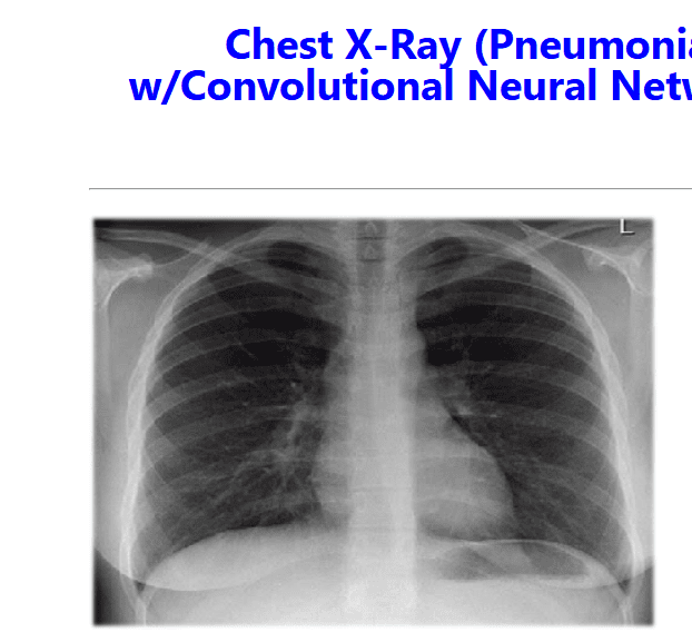 Chest X-Ray (Pneumonia)