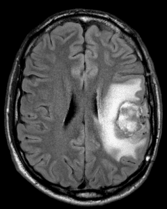 اكتشاف سرطان المخ عن طريق اشعة الرنين المغناطيسي MRI