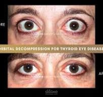 presentation about thyroid eye diseases