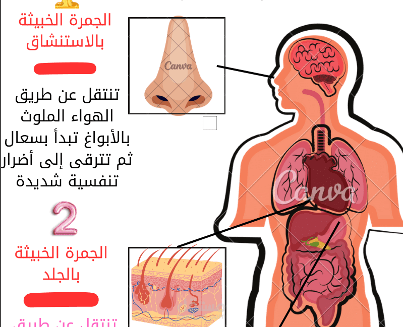 Infographic - فيروس الجمرة الخبيثة ، تم تصميمه على برنامج canva