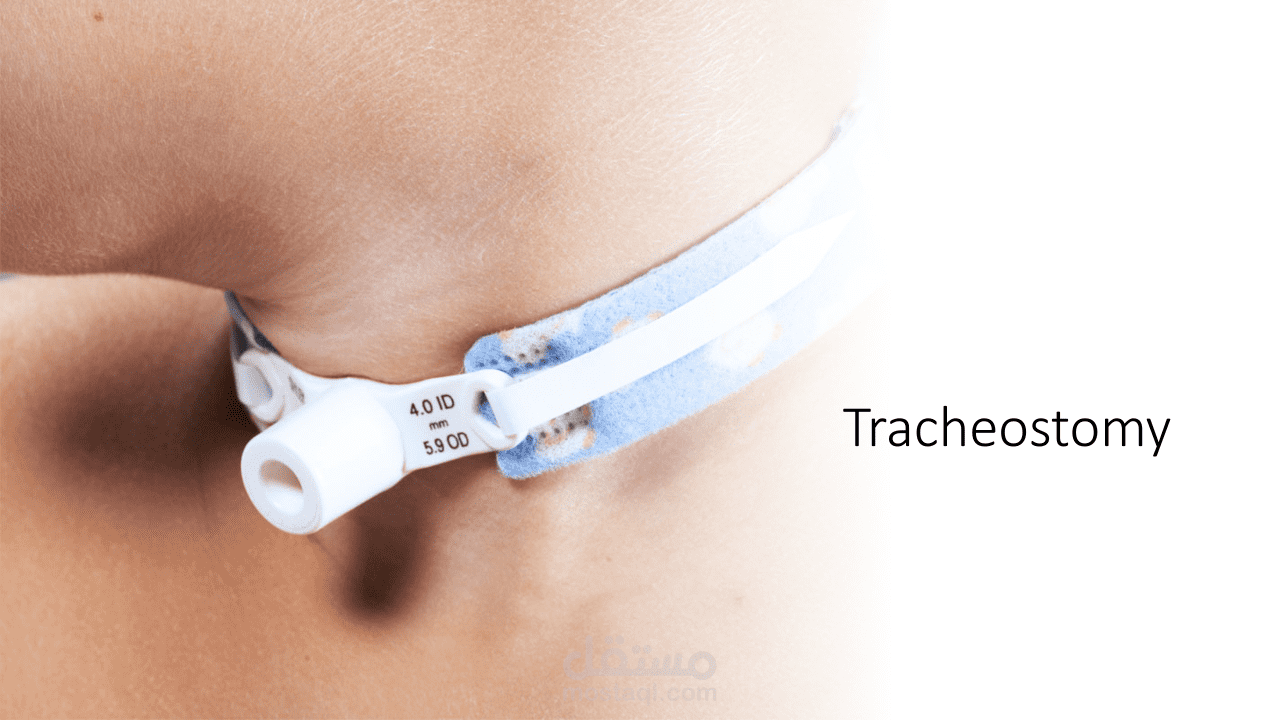 شق حنجري - tracheostomy