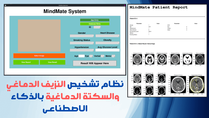 نظام تشخيص النزيف الدماغي والسكتة الدماغية بالذكاء الاصطناعى