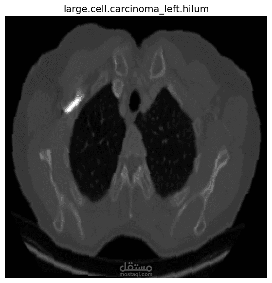 Chest CT-Scan Classification with ResNet18