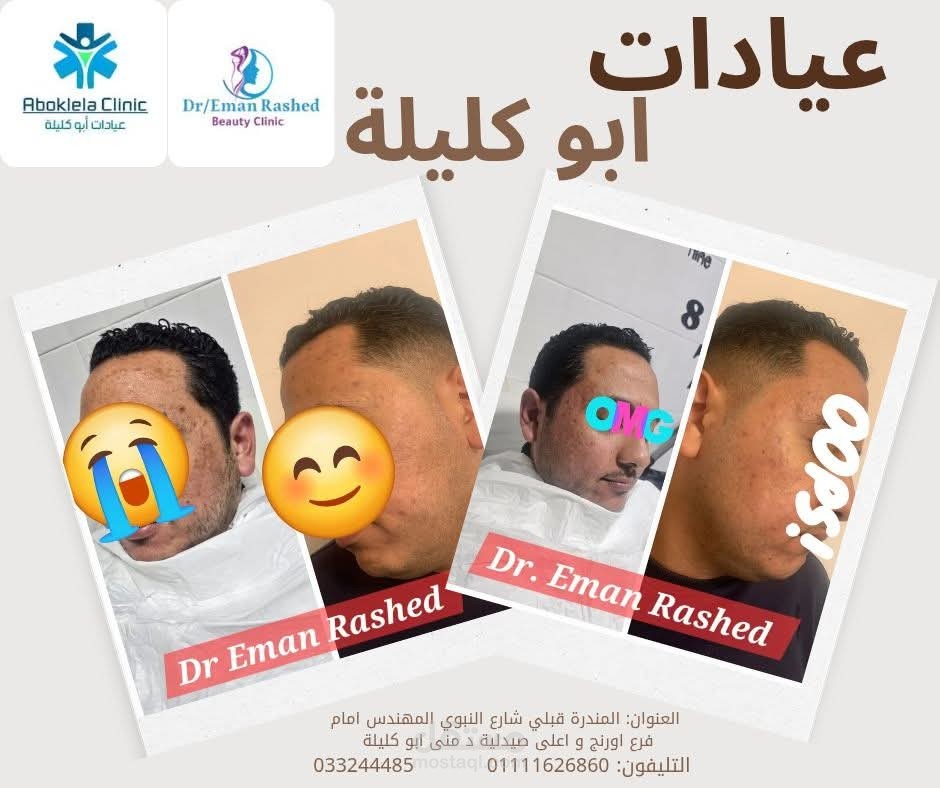 علاج اثار الحبوب و الندبات