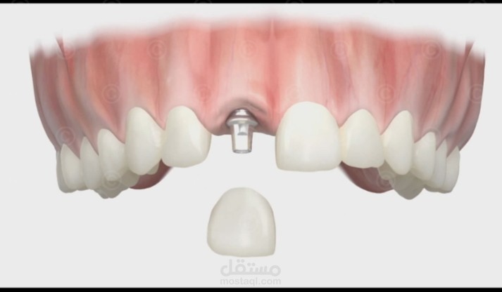Telescopic Overdenture in a Partially Edentulous Patient: A Case Report