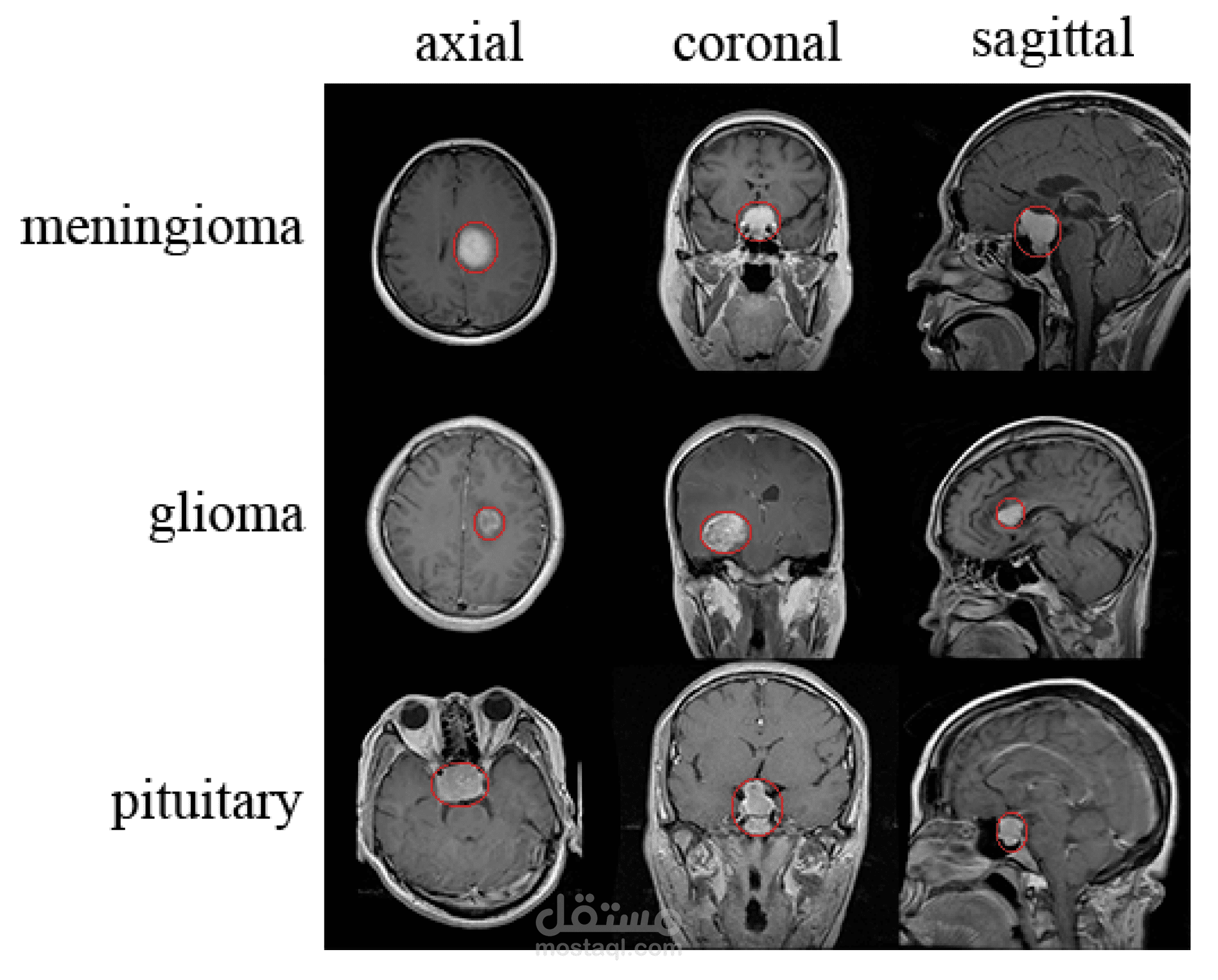 Brain Tumor Classification