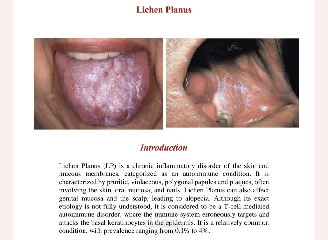 Lichen planus