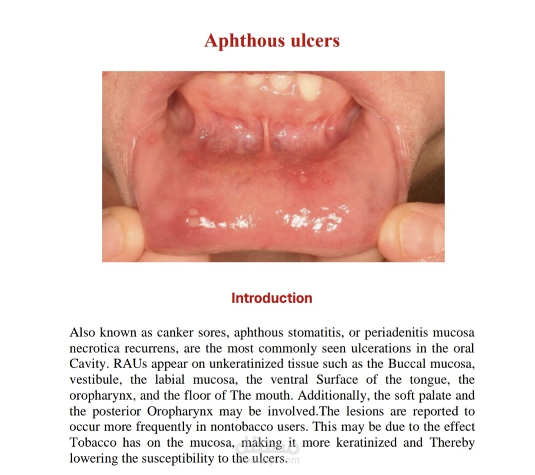 Apthus ulcer