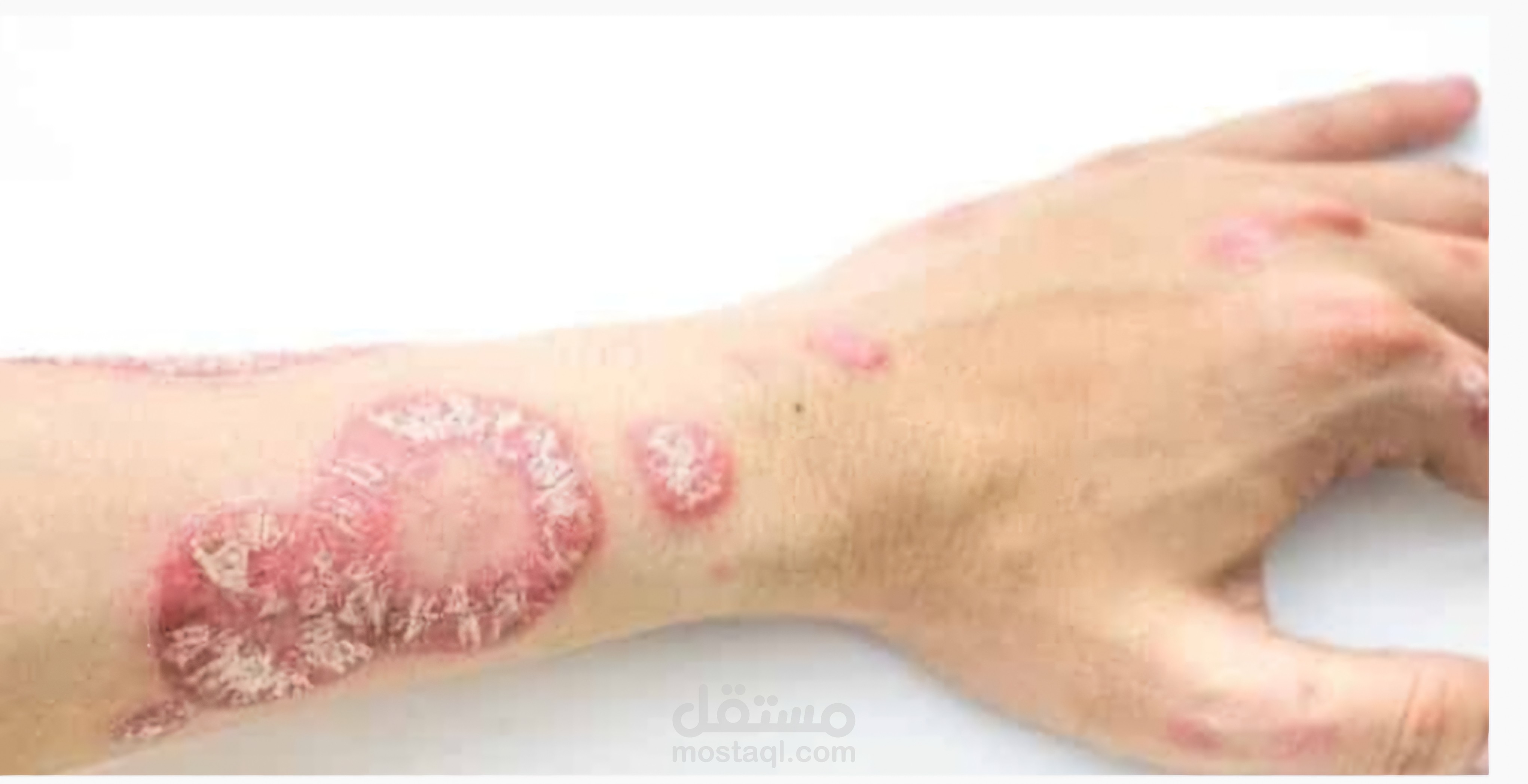 بحث طبي آخر عن مرض جلدي (الصدفيه الجلديه - chronic skin condition)