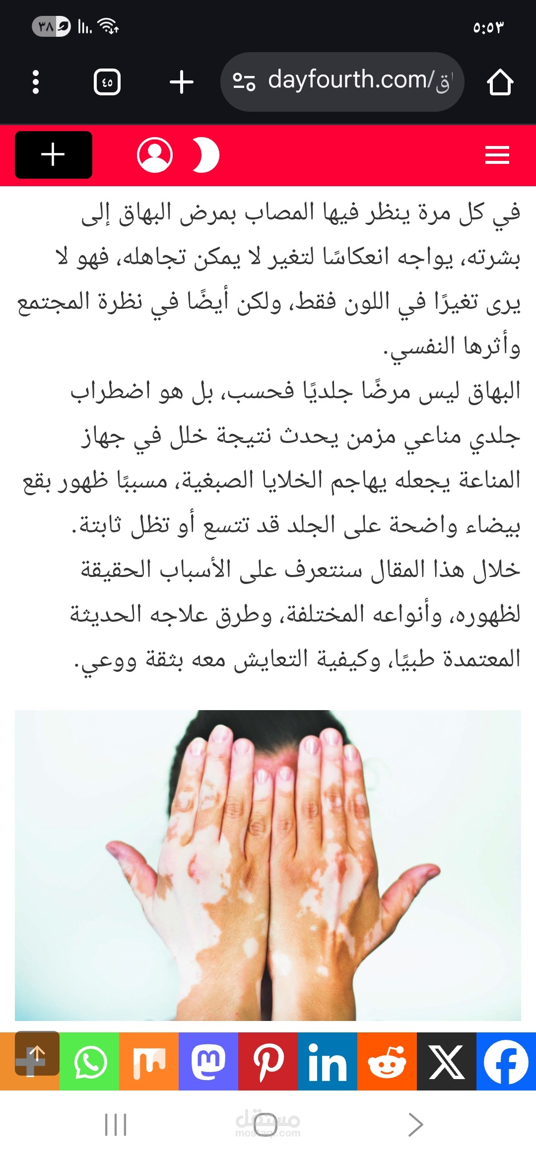مرض البهاق: الأسباب، طرق العلاج، والتوعية المجتمعية