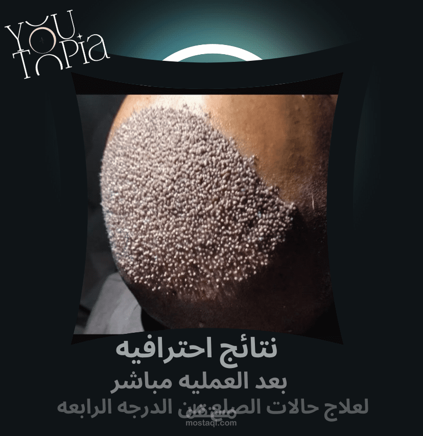 نتائج زراعة الشعر باحترافية عالية