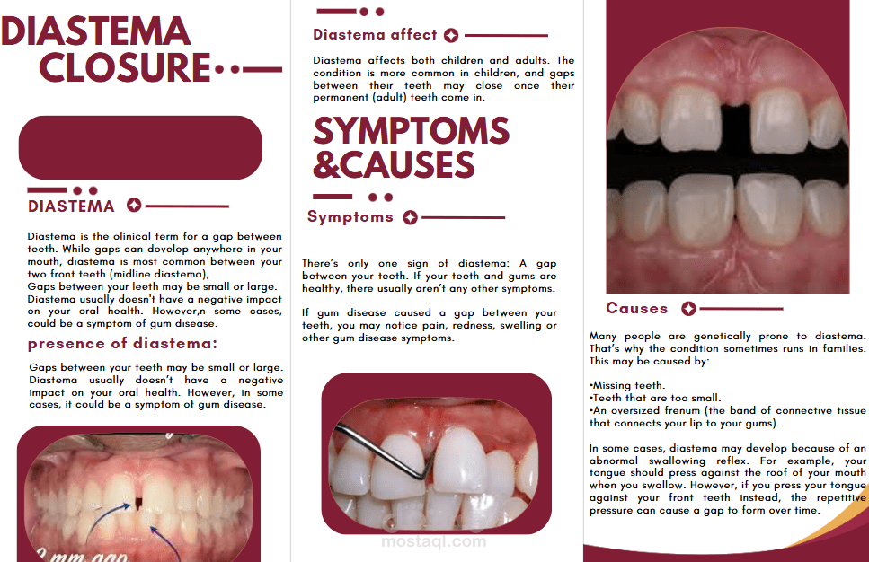 DIASTEMA  CLOSURE