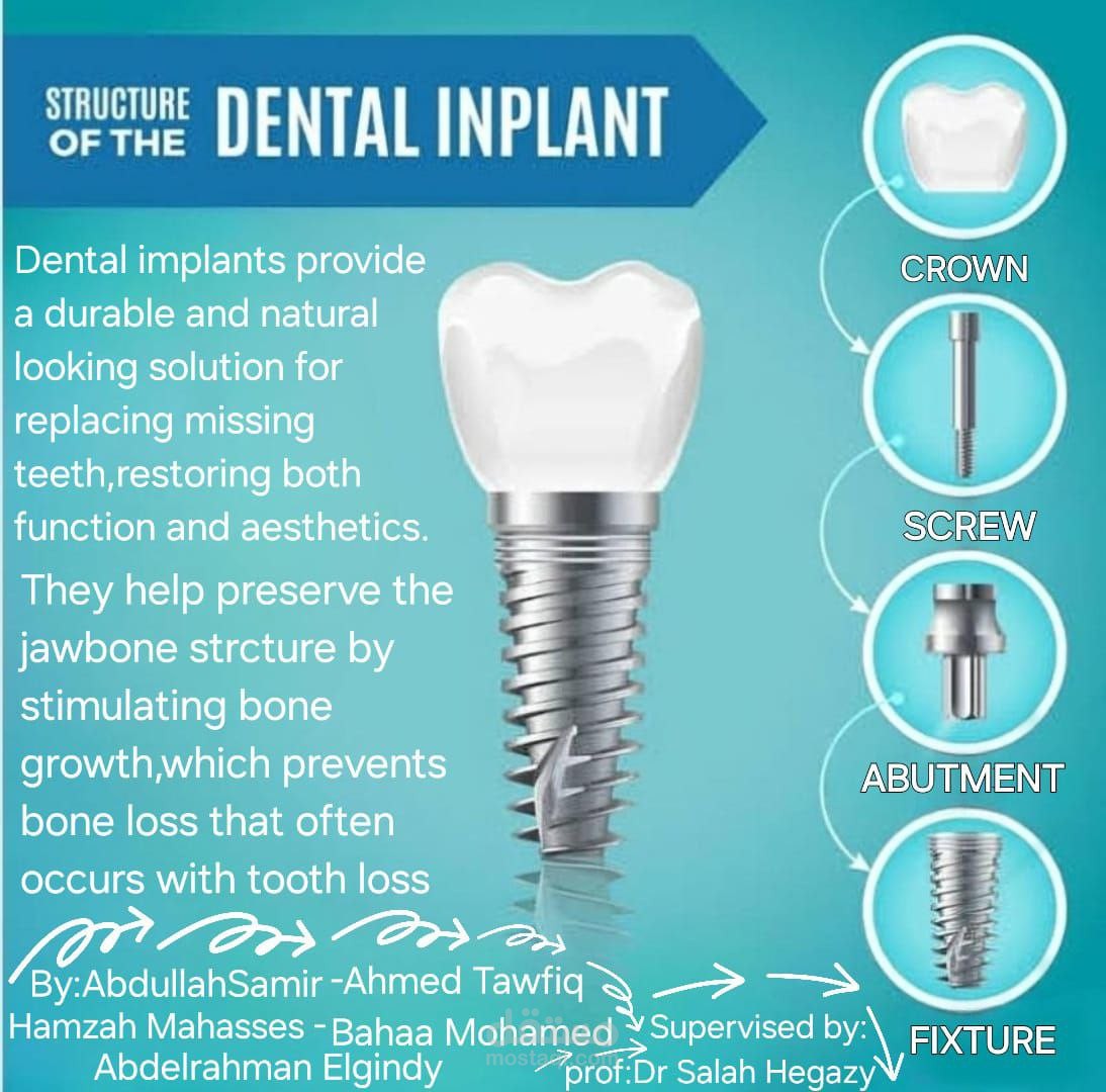 Informative Medical Poster – Dental Implant Structure Explained Visually