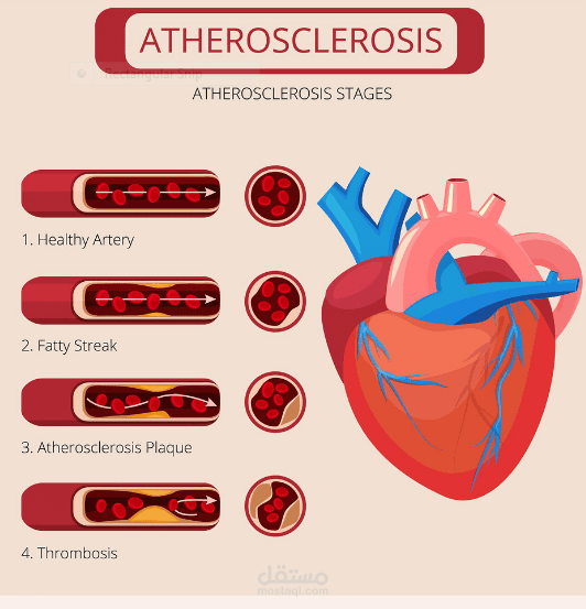 REPORT ABOUT ATHEROSCLEROSIS