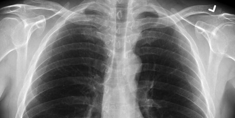 Chest X-Ray 6 Classes using CNN Model