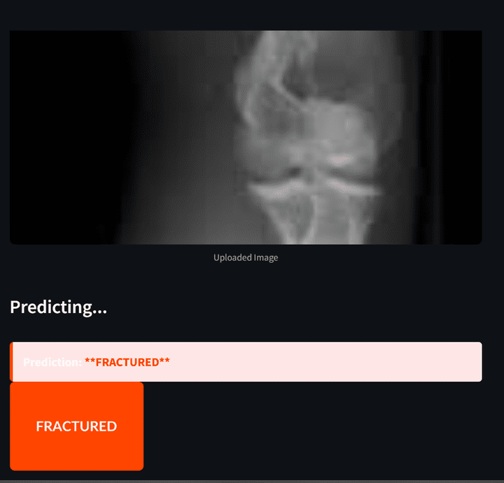 Bone Fracture Detection using Computer Vision