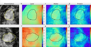 Breast Cancer Diagnosis Prediction Using Machine Learning