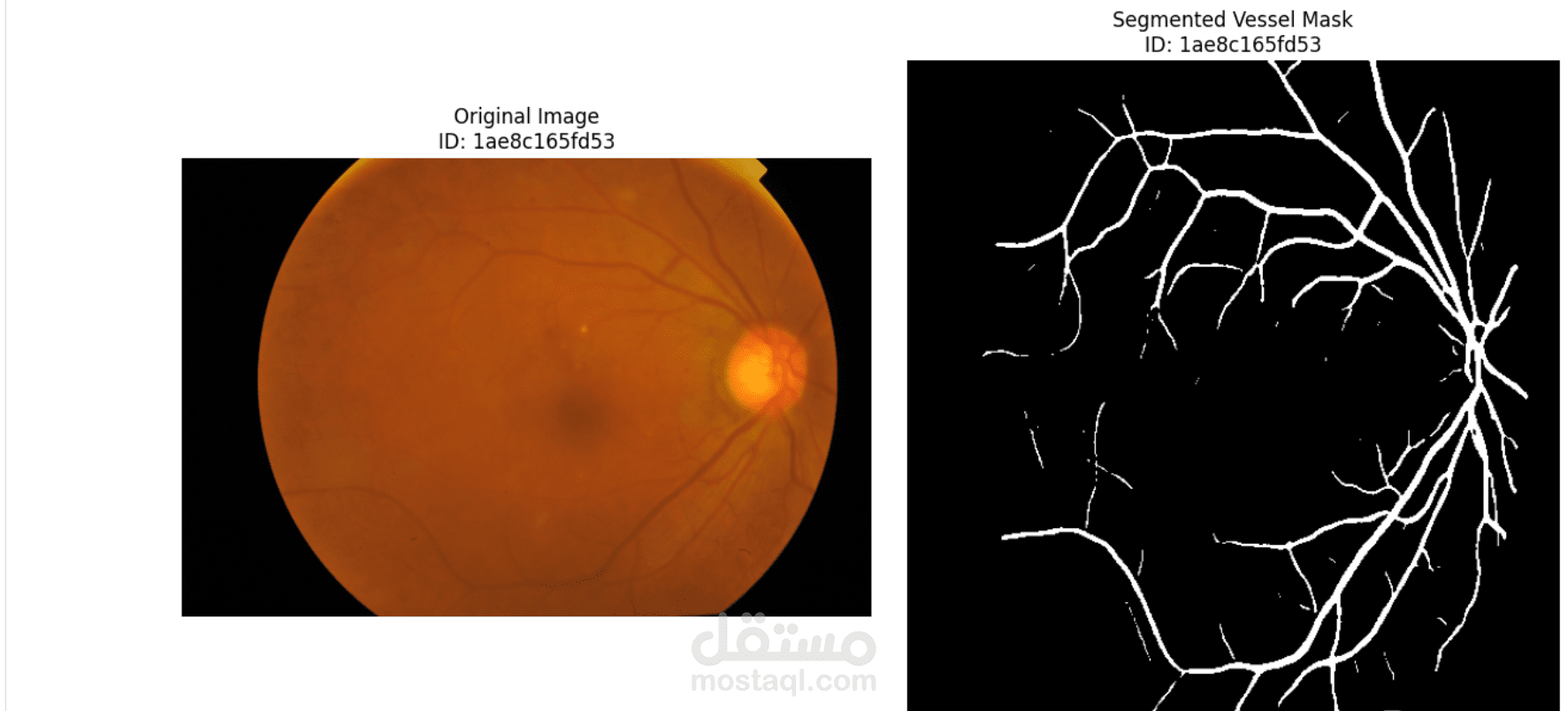 Diabetic Retinal Classification & Vessel Segmentation