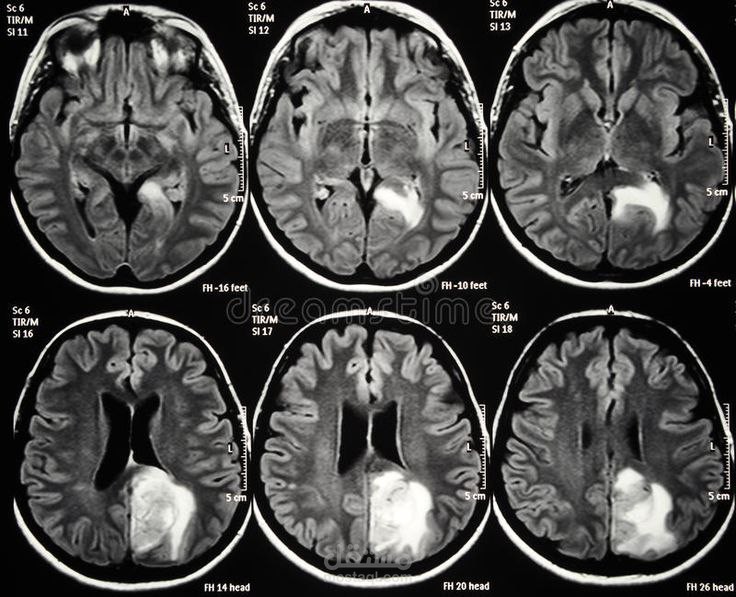 Brain Tumor Classification using Deep Learning