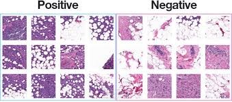 Breast Cancer Classification using Deep Learning