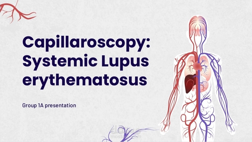 Systemic Lupus Erythematosus - Presentation