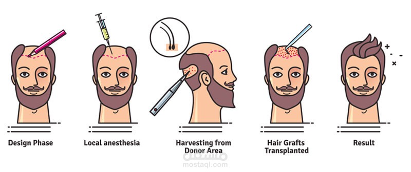 How hair transplant works cost.