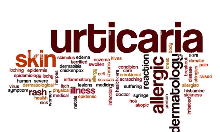 Urticaria