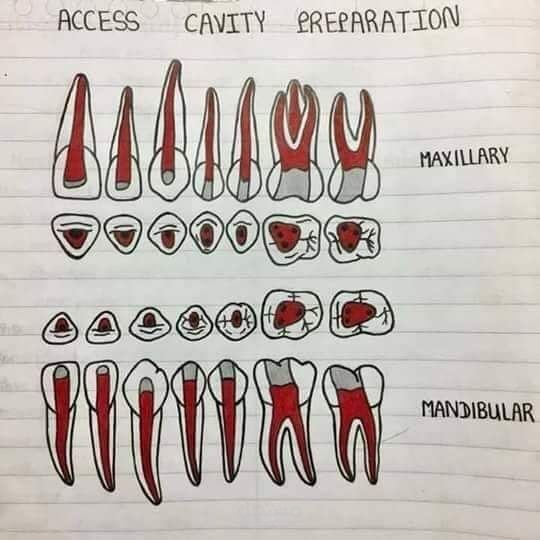 Access cavity preparation | مستقل