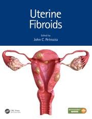 Uterine fibroids