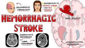 Hemorrhagic stroke