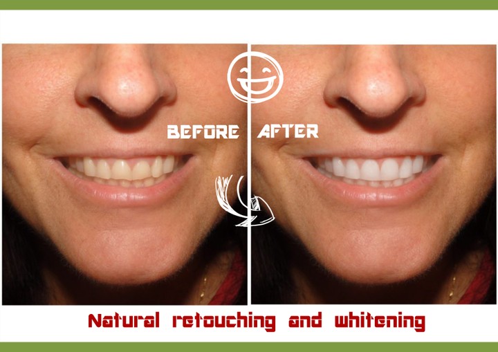 -تعديل شكل الأسنان و تبيضها/ Teeth retouching