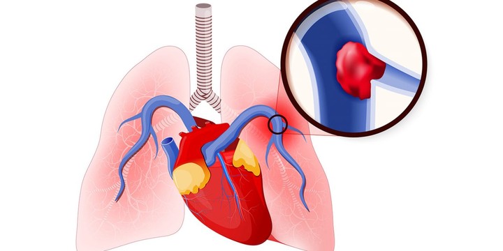 مقال علمي حول الانسداد الرئوي pulmonary embolism