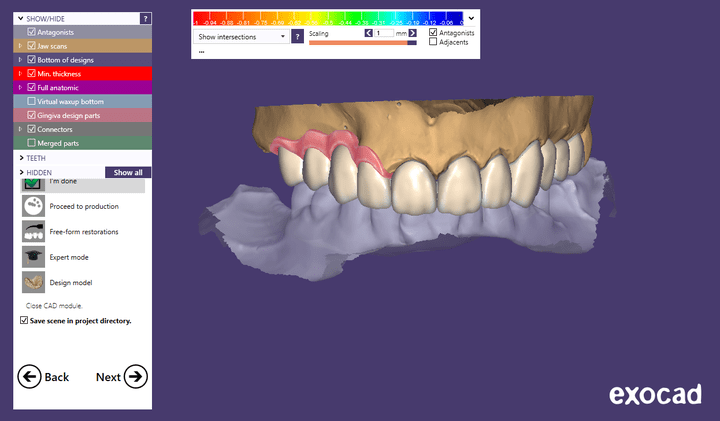 Upper fixed partial denture