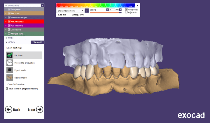 lower arch fixed partial dentures(bridges)