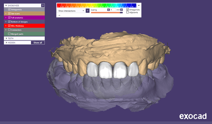 4 upper anterior crowns