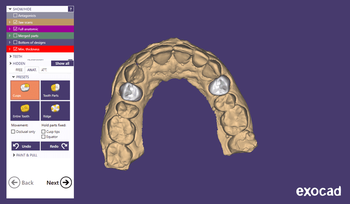 Upper 2 crowns for premolars