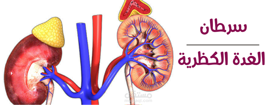 كتابة مقال عن سرطان الغددة الكظرية