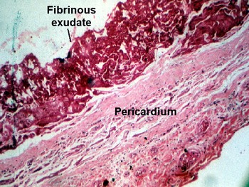 exudate of cells