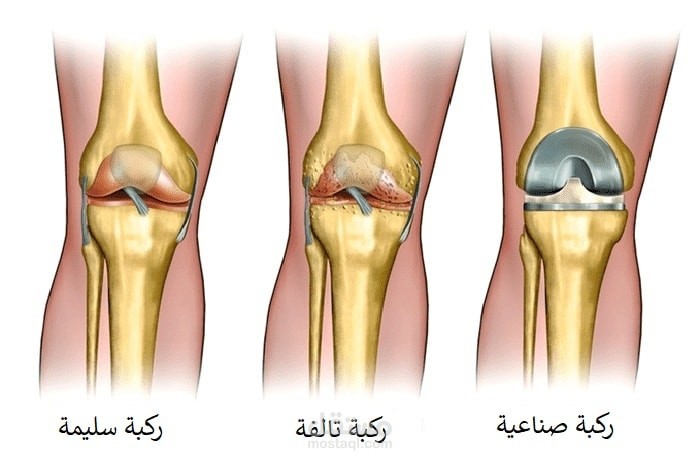 عملية تغيير مفصل الركبة