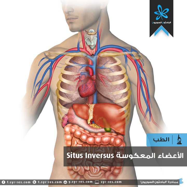 عندما تتوضع أحشاء الجسم في المكان المعاكس